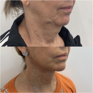 59-y.o-female-Awake-Deep-Plane-Facelift-and-Necklift-1-3