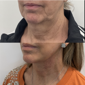 59-y.o-female-Awake-Deep-Plane-Facelift-and-Necklift-1-4