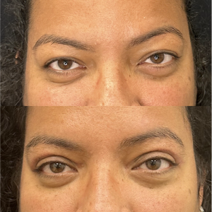 42-y.o-female-Upper-Blepharoplasty-1-1