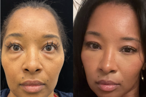 a-46-y.o-female-awake-Lower-Blepharoplasty-and-Facial-Fat-Transfer-1-1