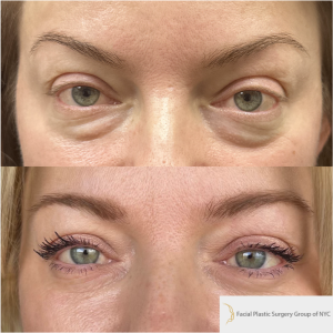 44-y.o-female-awake-scarless-lower-blepharoplasty-1-1