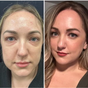 40-y.o-female-Awake-Lower-Blepharoplasty-1-1