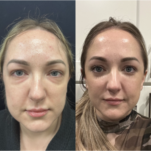 40-y.o-female-Awake-Lower-Blepharoplasty-1-2
