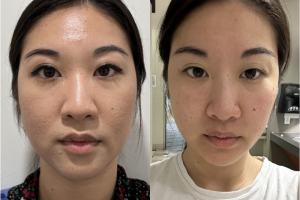 37-y.o-female-buccal-fat-reduction-1-1