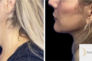 52-y.o-female-who-underwent-Deep-Plane-Facelift-Extended-Deep-plane-Neck-Lift-and-facial-fat-transfer-1