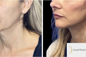 52-y.o-female-who-underwent-Deep-Plane-Facelift-Extended-Deep-plane-Neck-Lift-and-facial-fat-transfer-2