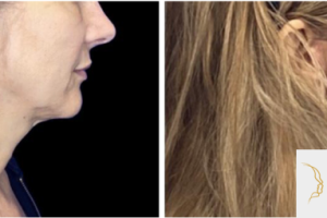 52-y.o-female-who-underwent-Deep-Plane-Facelift-Extended-Deep-plane-Neck-Lift-and-facial-fat-transfer-3