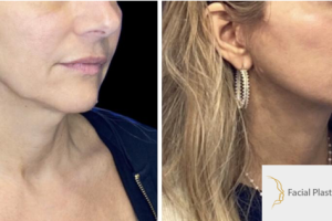 52-y.o-female-who-underwent-Deep-Plane-Facelift-Extended-Deep-plane-Neck-Lift-and-facial-fat-transfer-4