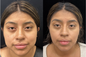 32-y.o-female-Facial-Slimming-Surgery-which-included-Buccal-Fat-Reduction-Chin-and-Neck-Liposuction-1-1