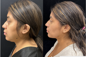 32-y.o-female-Facial-Slimming-Surgery-which-included-Buccal-Fat-Reduction-Chin-and-Neck-Liposuction-1-2