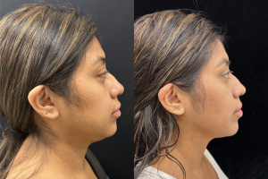 32-y.o-female-Facial-Slimming-Surgery-which-included-Buccal-Fat-Reduction-Chin-and-Neck-Liposuction-1-3