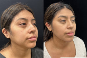 32-y.o-female-Facial-Slimming-Surgery-which-included-Buccal-Fat-Reduction-Chin-and-Neck-Liposuction-1-4