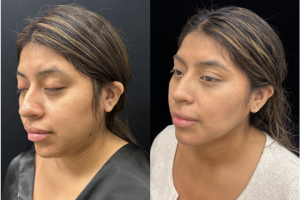 32-y.o-female-Facial-Slimming-Surgery-which-included-Buccal-Fat-Reduction-Chin-and-Neck-Liposuction-1-5