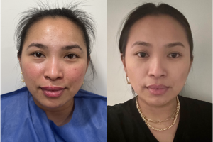33-y.o-female-buccal-fat-reduction-tapered-lower-face-1-1