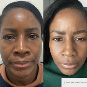 50-y.o-female-buccal-fat-reduction-demonstrating-tapered-lower-face-1-1