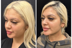 30-y.o-female-chin-and-neck-liposculpting-1-1