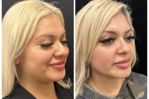 30-y.o-female-chin-and-neck-liposculpting-1-2