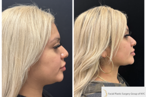 30-y.o-female-chin-and-neck-liposculpting-1-3