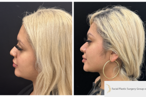 30-y.o-female-chin-and-neck-liposculpting-1-4