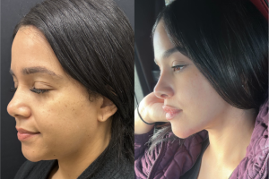 40-y.o-female-chin-and-neck-liposculpting-1-1