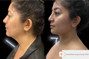 35-y.o-female-chin-neck-liposculpting-with-facetite-1-1