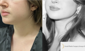 25-y.o-female-chin-neck-Liposculpting-1-1