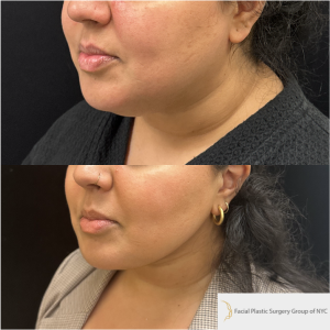 28-y.o-female-Chin-Neck-Liposuction-and-facetite-1-1