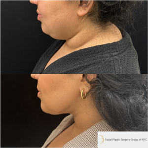 28-y.o-female-Chin-Neck-Liposuction-and-facetite-1-2