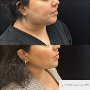28-y.o-female-Chin-Neck-Liposuction-and-facetite-1-4