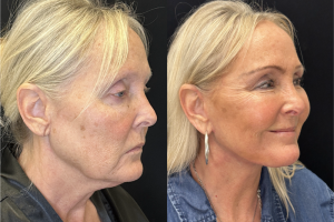 60-y.o-female-Deep-Plane-Facelift-Necklift-1-1