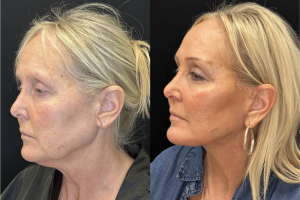 60-y.o-female-Deep-Plane-Facelift-Necklift-1-2