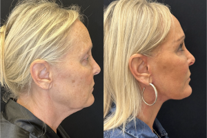 60-y.o-female-Deep-Plane-Facelift-Necklift-1-3