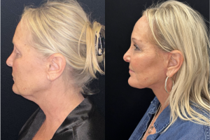 60-y.o-female-Deep-Plane-Facelift-Necklift-1-4