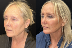 60-y.o-female-Deep-Plane-Facelift-Necklift-1-5