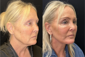 60-y.o-female-Deep-Plane-Facelift-Necklift-1-6
