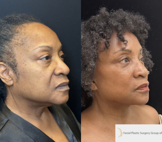 SR-66-y.o-female-who-underwent-Deep-Plane-Facelift-Necklift-and-is-now-6-months-out-from-the-surgery-1-1-