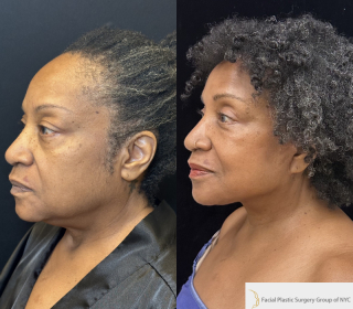 SR-66-y.o-female-who-underwent-Deep-Plane-Facelift-Necklift-and-is-now-6-months-out-from-the-surgery-1-2