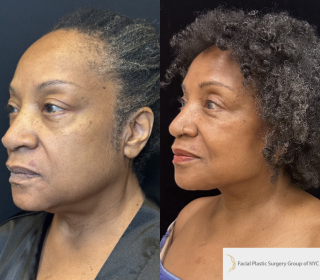 SR-66-y.o-female-who-underwent-Deep-Plane-Facelift-Necklift-and-is-now-6-months-out-from-the-surgery-1-3