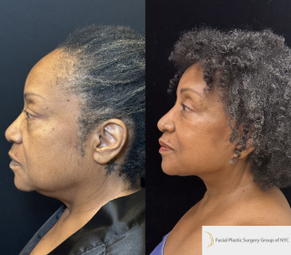 SR-66-y.o-female-who-underwent-Deep-Plane-Facelift-Necklift-and-is-now-6-months-out-from-the-surgery-1-4