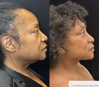 SR-66-y.o-female-who-underwent-Deep-Plane-Facelift-Necklift-and-is-now-6-months-out-from-the-surgery-1-5
